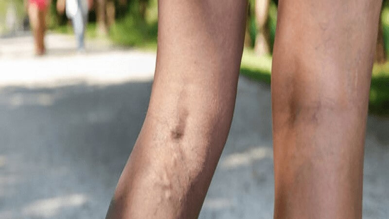 Krampfadern? Diese Lebensmittel werden Sie vor einer Operation schützen